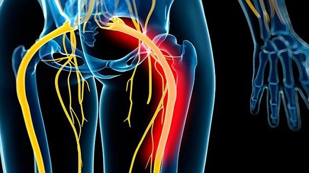 رگ سیاتیک چیست؟