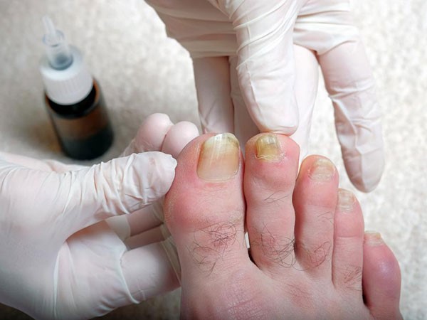عفونت ناخن پا چیست و چگونه ایجاد می‌شود؟
